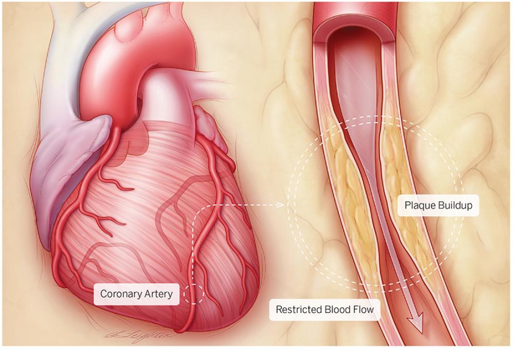 بیماری عروق کرونر قلب: علائم، علل و راه‌های پیشگیری